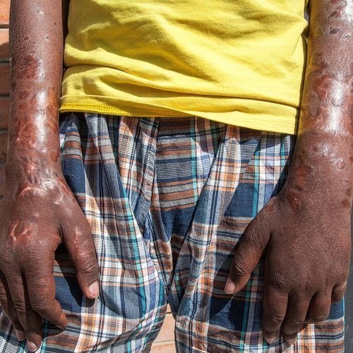 More leprosy cases are popping up in Florida. Here’s what to know.