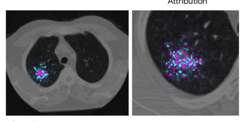Google shows how AI might detect lung cancer faster and more reliably