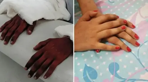 Mujer recibió trasplantes de manos masculinas que se hicieron más femeninas con el tiempo