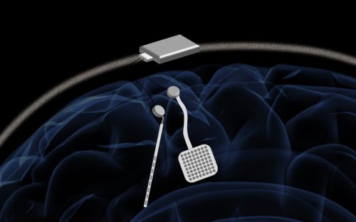 Brain ‘pacemaker’ could prevent tremors and seizures for Parkinson’s and epilepsy sufferers