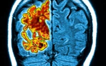 Alzheimer’s could be triggered by medical procedures, study suggests