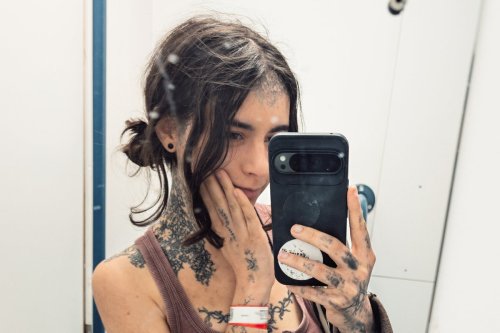 Student’s ‘party trick’ of dislocating joints and stretching skin turns out to be rare condition