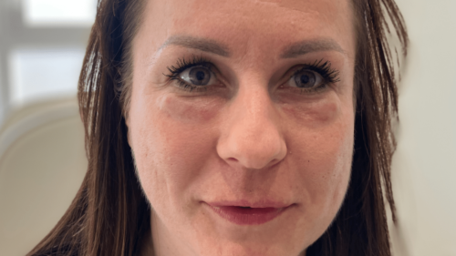 BOTCH JOB ‘It’s hard to look in the mirror’ says beauty fan as Botox changes skin colour and leaves huge lumps under her eyes