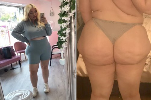 New York Jury Awards Woman Million For A Botched Plastic Surgery