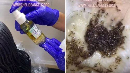 We're head lice experts - our most horrific case had hair 'moving' with bugs