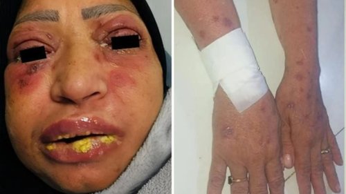 DRUG DANGER Shocking photos show woman’s horrific reaction to ibuprofen that left her oozing yellow gunk from eyes & scales on skin