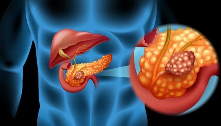 Breakthrough mRNA vaccine reinvents pancreatic cancer treatment