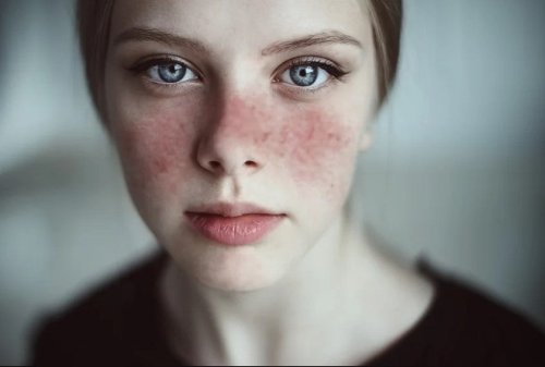 Game changing new molecule treats autoimmune diseases, including lupus and Crohn’s disease