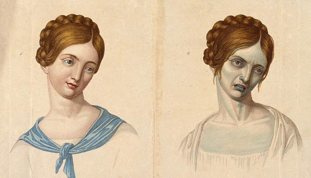 Romanticizing Death: Art in the Age of Tuberculosis