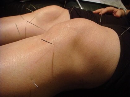 Can Acupuncture Help Arthritis?