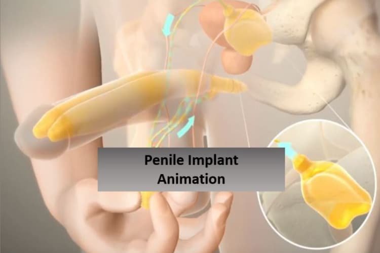 Penile Implants – A treatment for Impotence