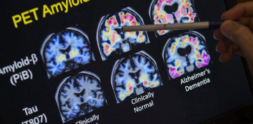 Alzheimer’s might not be primarily a brain disease. A new theory suggests it’s an autoimmune condition.