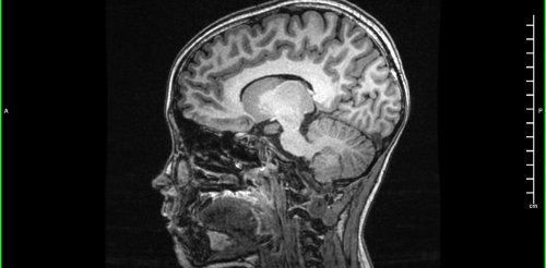 Santé mentale et soins psychiques de l’enfant : les impasses du « tout biologique »