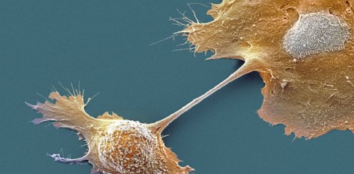 Breakthrough drug nearly doubles survival with advanced pancreatic cancer
