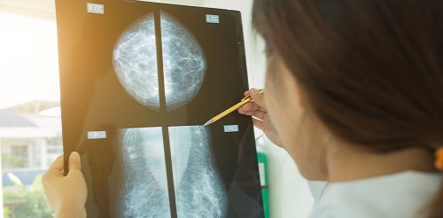 Breast cancer diagnosis by AI now as good as human experts