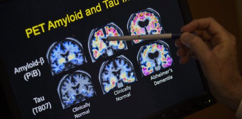 L’Alzheimer pourrait être une maladie auto-immune, et non pas une pathologie du cerveau