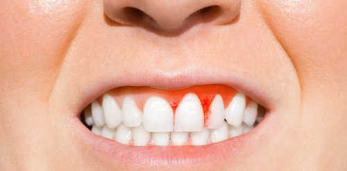 Four health conditions linked to gum disease