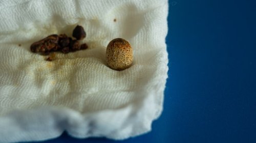 Scientists make concerning finding while studying contents inside human gallstones: 'This underscores the need for greater awareness'
