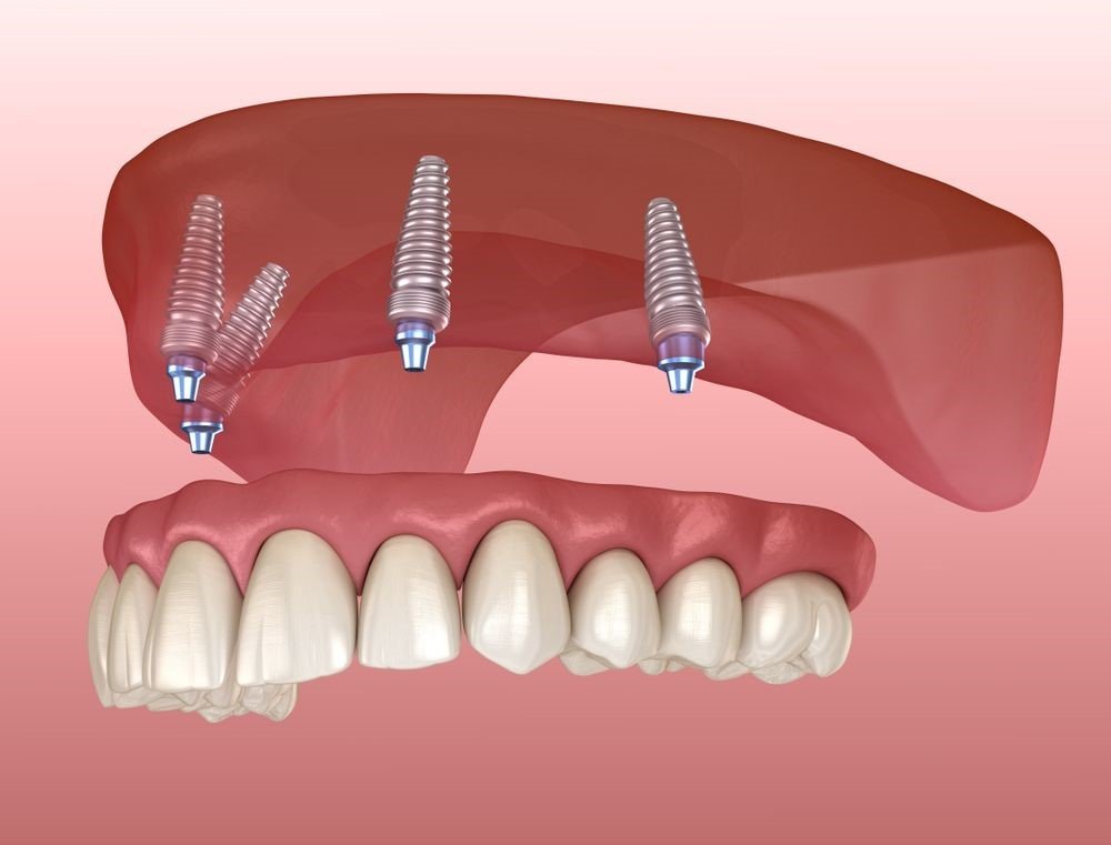 https://www.storeboard.com/blogs/seniors/benefits-of-experiencing-dental-implants/5018428 - cover