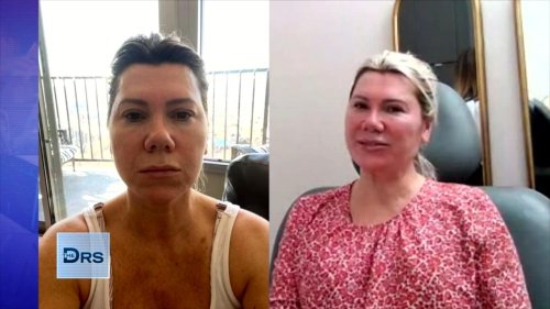 See Woman’s Before and After Filler ‘Glow Up’