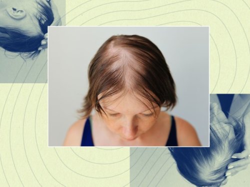 Revive Your Locks: Menopause, Alopecia & Steps to Regain Hair Growth