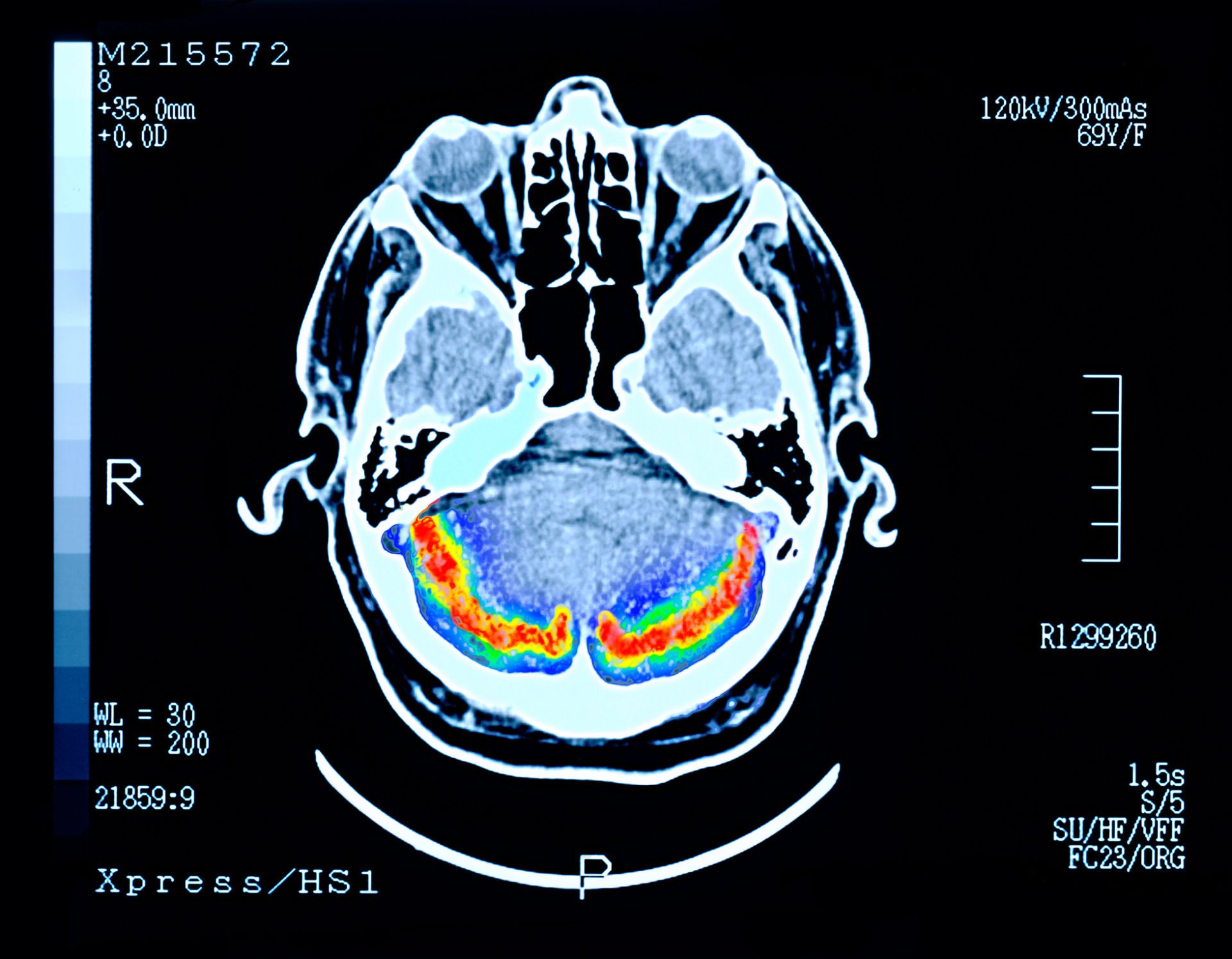 Potential new Alzheimer's disease treatment is already in use - and it's promising