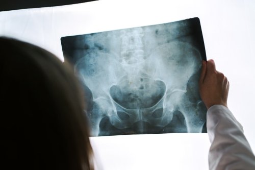 Can you prevent hip replacement surgery?