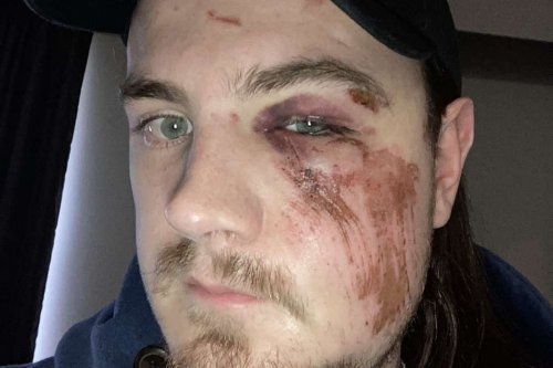 Injured Quebec man says his surgery in B.C. was cancelled after being told home province ‘won’t pay’ for procedure