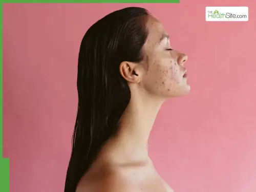 Impact Of Hormonal Changes On Women's Skin: Key Care Tips