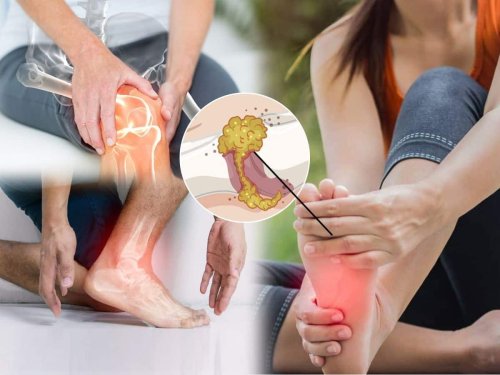 High Uric Acid Home Remedies: 7 Ayurvedic Herbs To Naturally Control Uric Acid Levels and Reduce Joint Pain