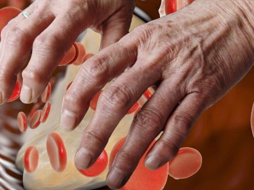 High Cholesterol In Men: Top 7 Unusual Symptoms of High LDL Bad Cholesterol In Hands And Fingers