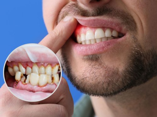 Bleeding Gums? 5 Effective Home Remedies to Prevent Oral Cavities at Home Without Medication