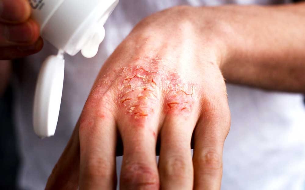 Yes, There’s a Miracle Trick to Relieve Eczema—and It’s Unbelievably Simple