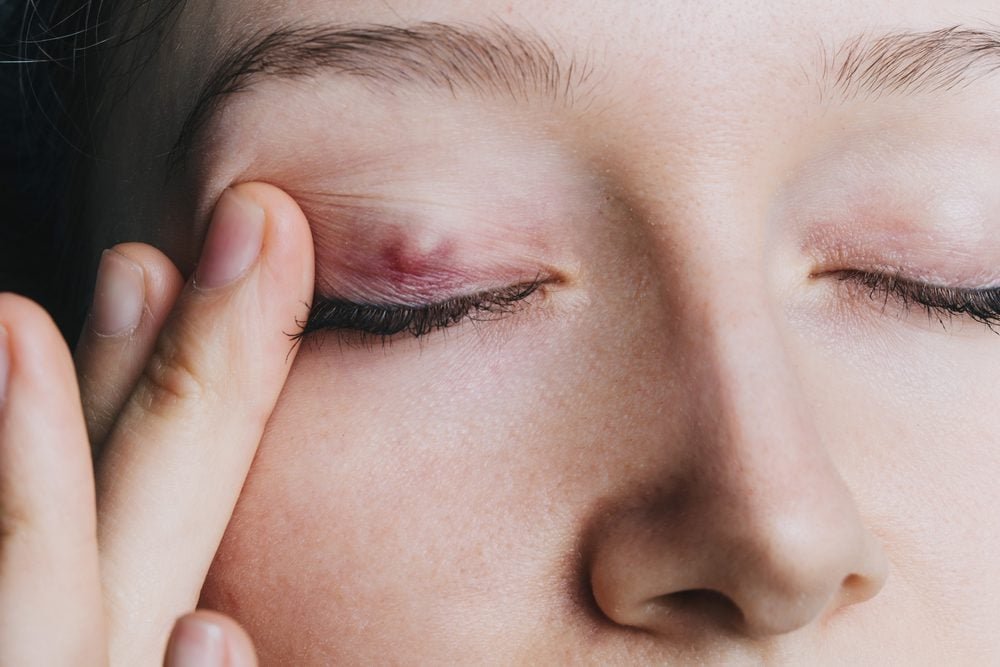 How to Get Rid of a Stye—the Right Way