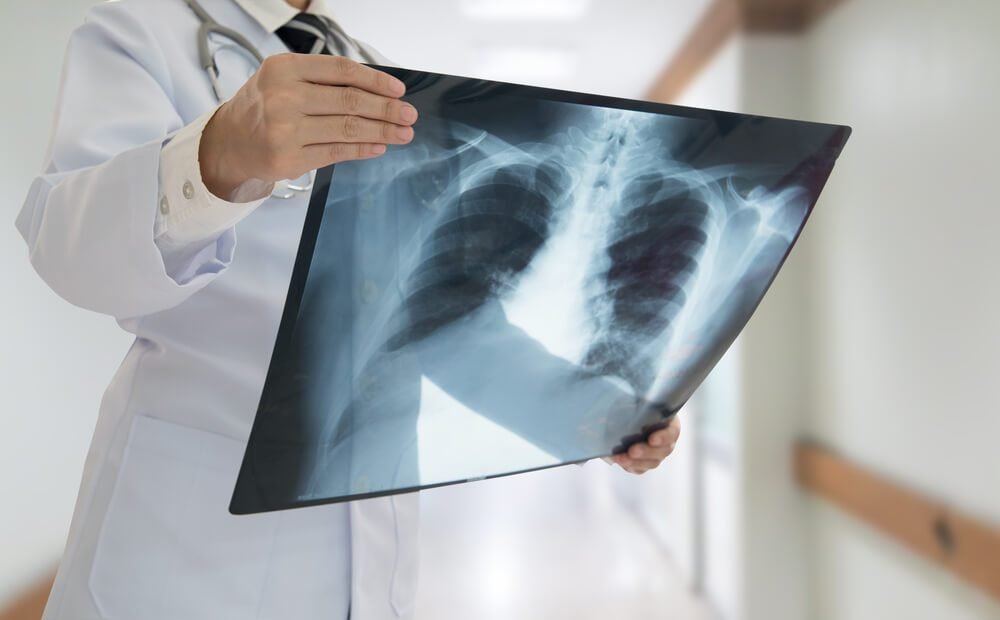 11 Things About Lung Cancer Doctors Wish You Knew