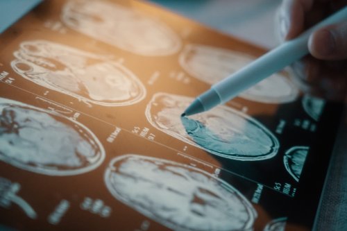New Study: This Common Procedure May Increase Cancer Risk