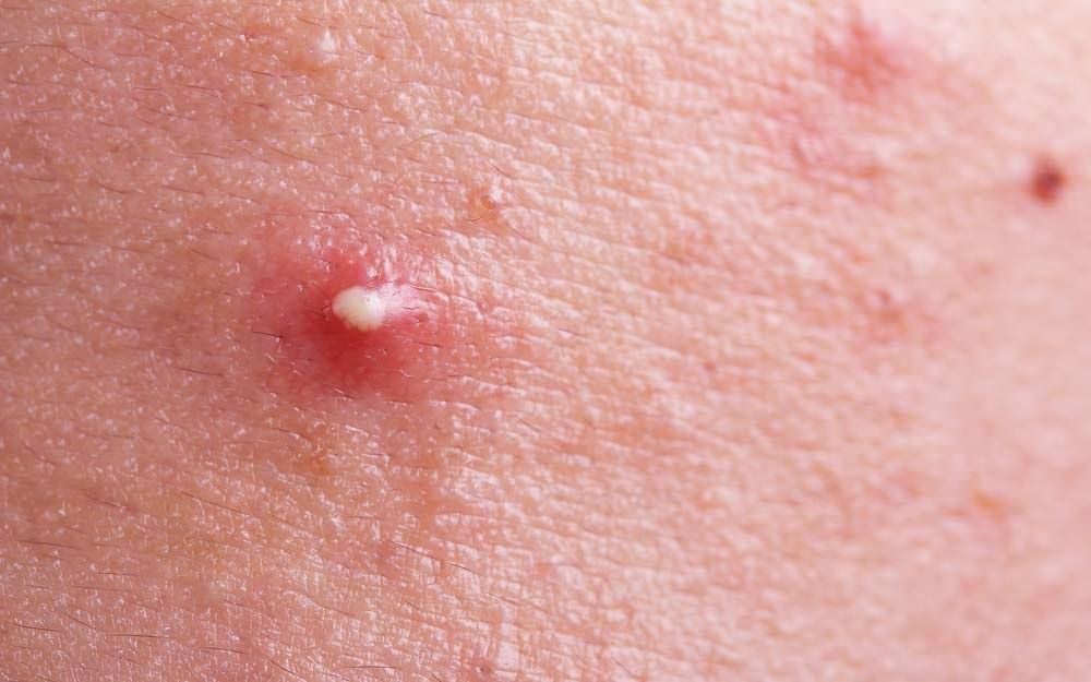 Why You Should Never, Ever Pop a Pimple in The “Danger Triangle”