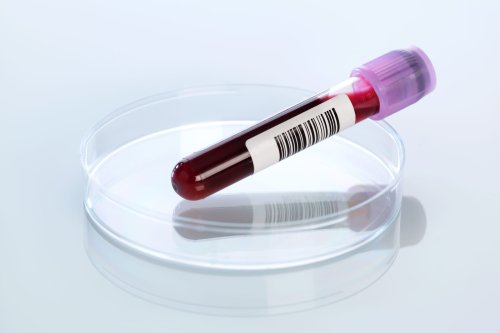 A Simple New Test Is Identifying Up to 100% of Early-Stage Cancer Cases