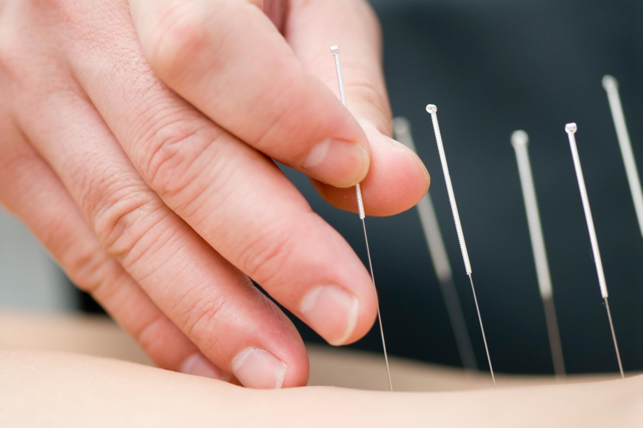 Acupuncture to This Surprising Body Part May Help You Lose Weight, Says New Study