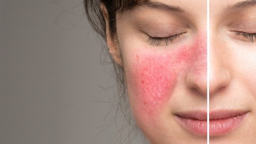 skincare-ingredients-to-avoid-if-you-have-rosacea-flipboard