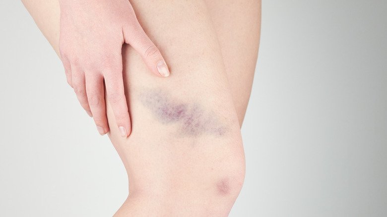 What Does It Mean When You Bruise Easily?