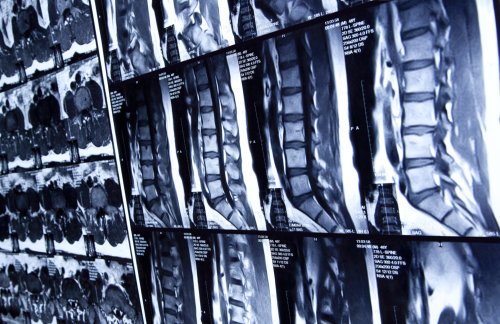 Scientists Make Breakthrough in Undoing Spine Injuries