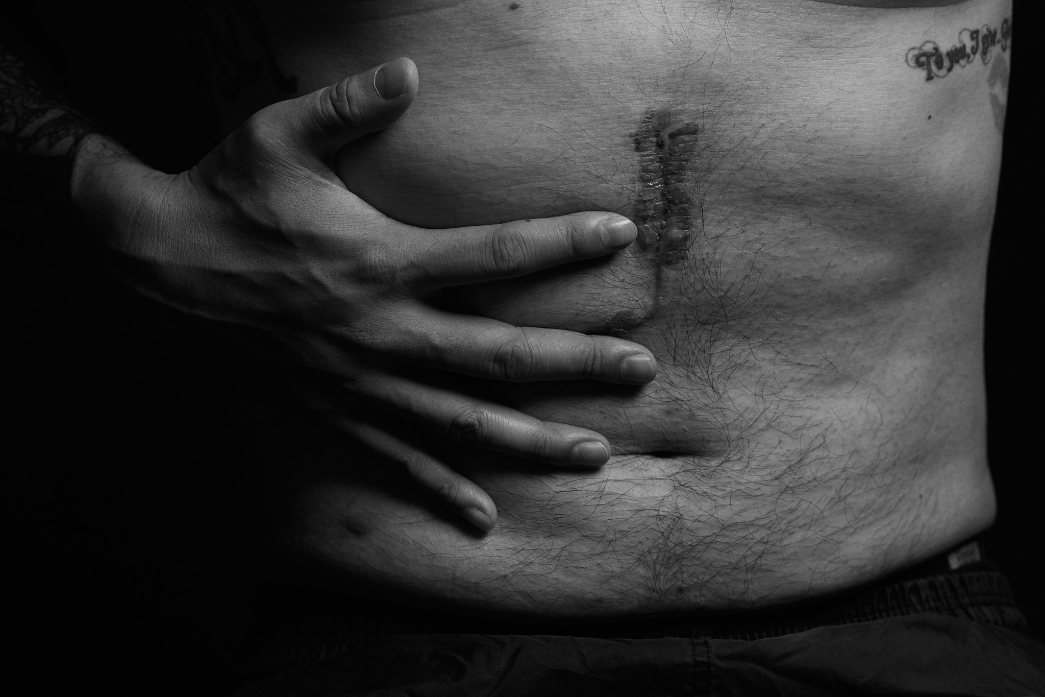 Beauty Beyond Scars Uses Black and White to Look Past Tragedy