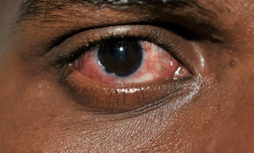 Pink eye infection on the rise in KZN
