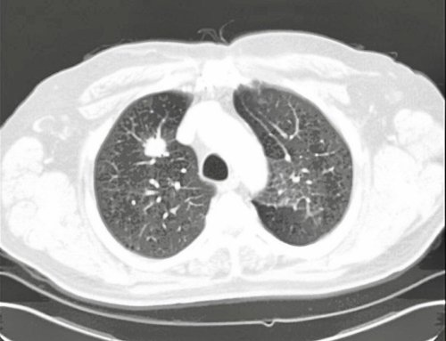 Detecting lung cancer early, even without symptoms