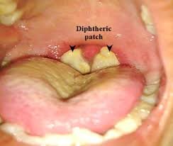 23 new cases of diphtheria recorded as Lagos tops list with 20 – NCDC