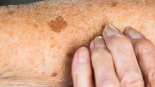 How to tell the difference between a harmless age spot and killer mole