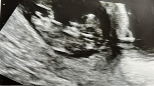 Scots gran shocked after grandchild’s ultrasound image looks like Elvis ...