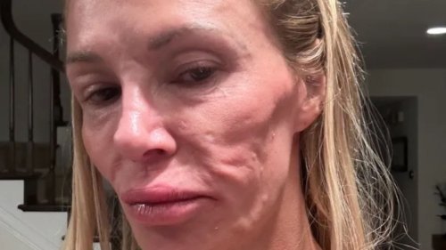 Celebrity Big Brother star looks unrecognisable with swollen face after losing FIVE teeth in shock health battle