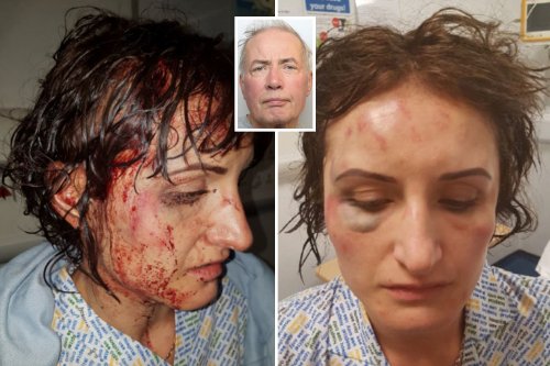 Defiant woman releases shocking pics of horrific injuries after violent ex attacked her with a hammer